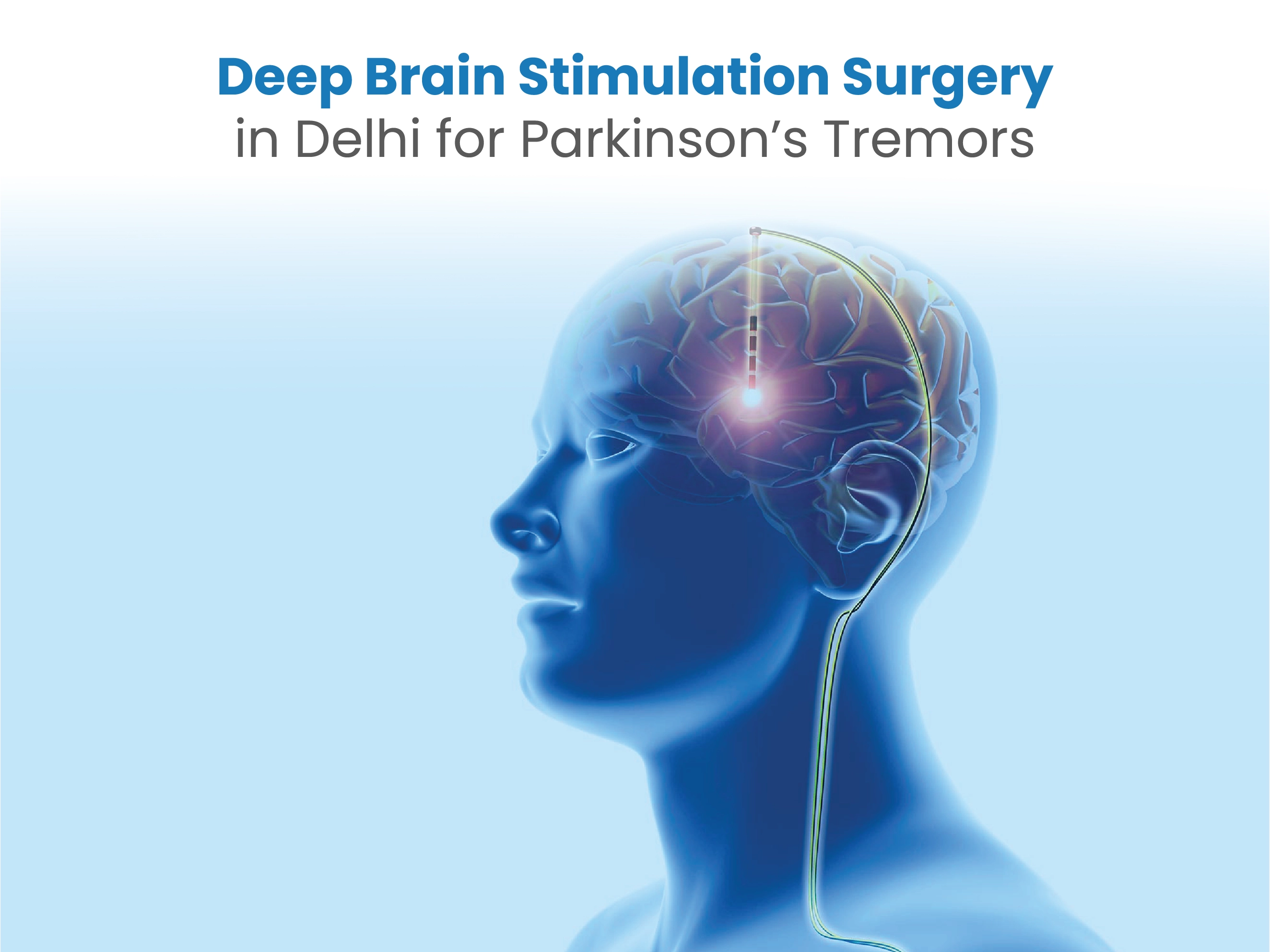Deep Brain Stimulation Surgery in Delhi for Parkinson’s Tremors